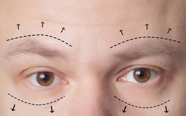 Como funciona o procedimento de Blefaroplastia?