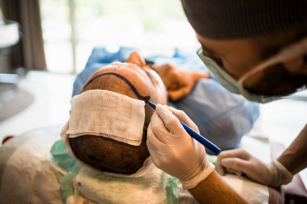 Melhores clínicas de transplante capilar em BH